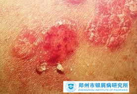 牛皮癣有什么护理知识