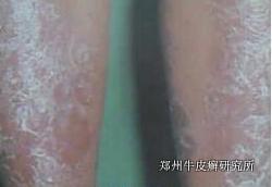 牛皮癣养生
