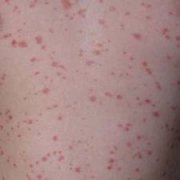 脓疱型牛皮癣和湿疹的区别在哪