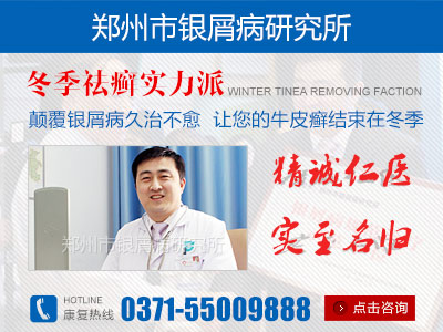 郑州治疗银屑病最正规医院