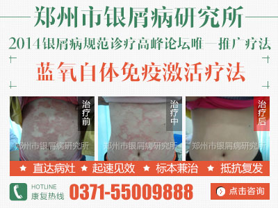 治疗牛皮癣方法