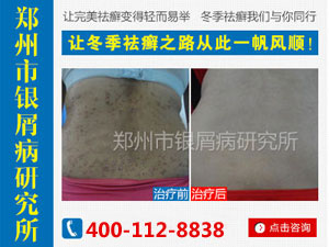 牛皮癣可不可以根治