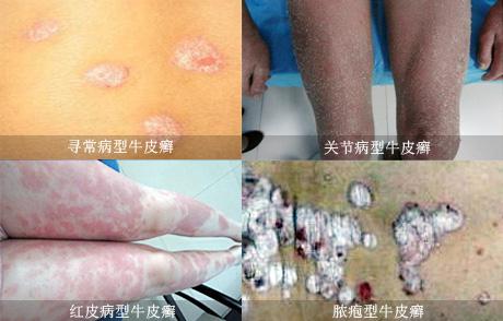银屑病的预防保健有注意呢