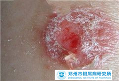 面部牛皮癣怎么治疗