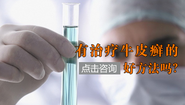 牛皮癣治疗