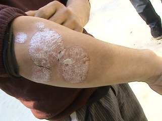 治疗早期银屑病有哪种方法