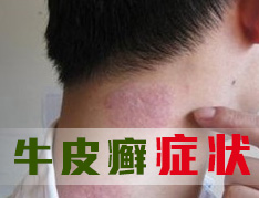 急性牛皮癣有哪些特征?