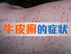 牛皮癣的表现形式都有什么?
