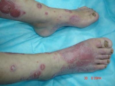 脚部牛皮癣的发病原因有哪些