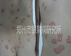 8岁儿童战胜银屑病 拥抱快乐童年