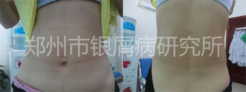 夫妻共同抗击银屑病 成为健康的赢家