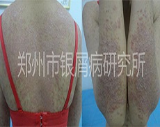 夫妻共同抗击银屑病 成为健康的赢家
