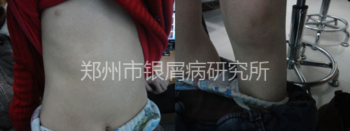 8岁儿童战胜银屑病 拥抱快乐童年