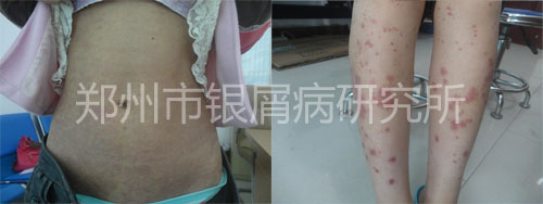 夫妻共同抗击银屑病 成为健康的赢家