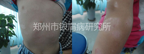 8岁儿童战胜银屑病 拥抱快乐童年